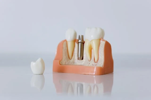 Who Is a Good Candidate for Implant Retained Dentures