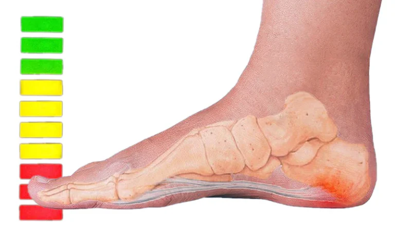 Plantar Fasciitis Treatments That Actually Work: A Straight-Talking Guide for Anyone Fed Up With Heel Pain